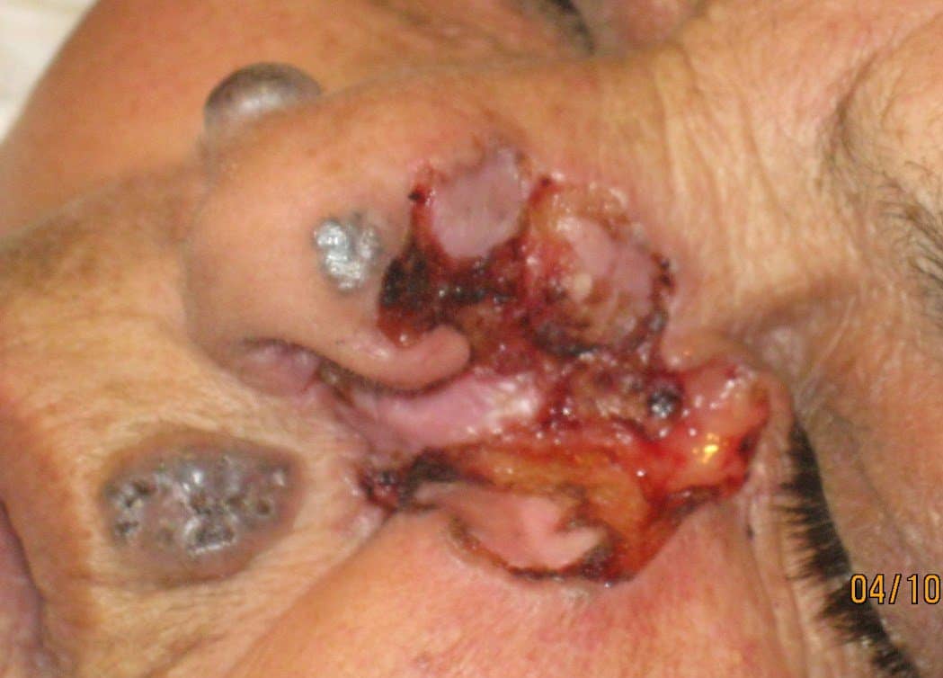 carcinoma