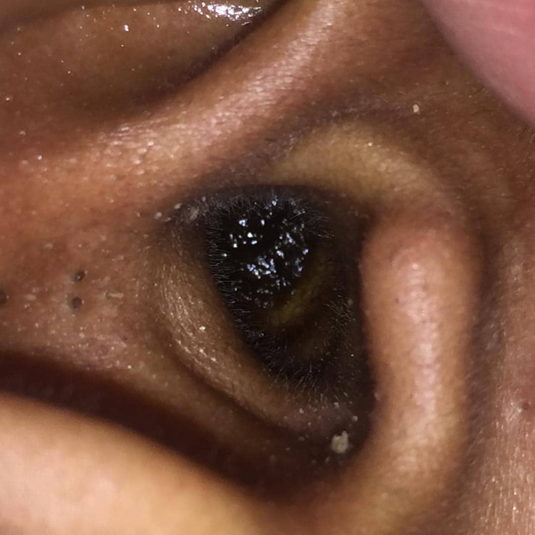 ear wax what is an ear wax
