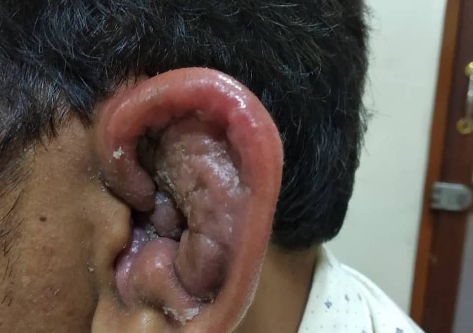 Perichondritis – Cauliflower ear – Cotton Ear Bud Damage