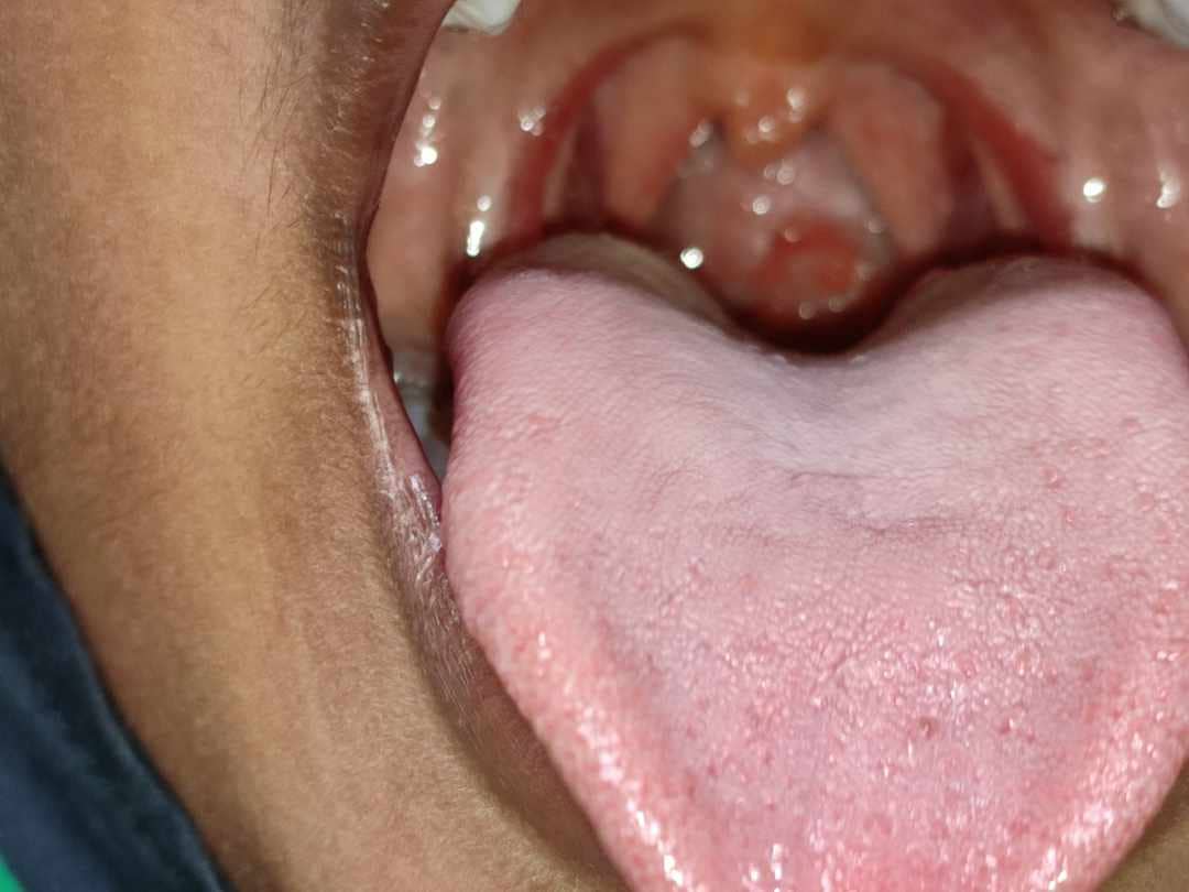 dry cough due to post nasal drip