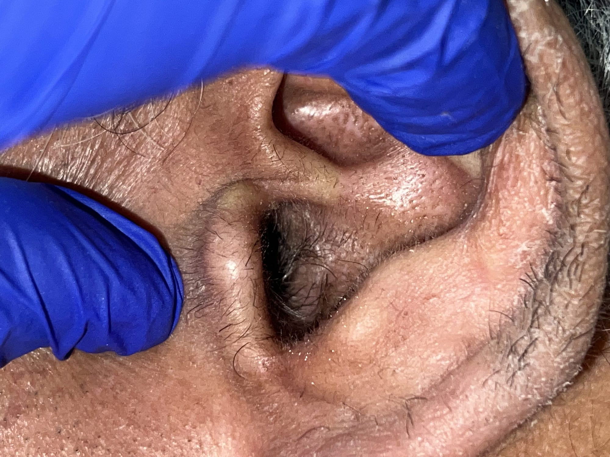 ear wax inside ear canal