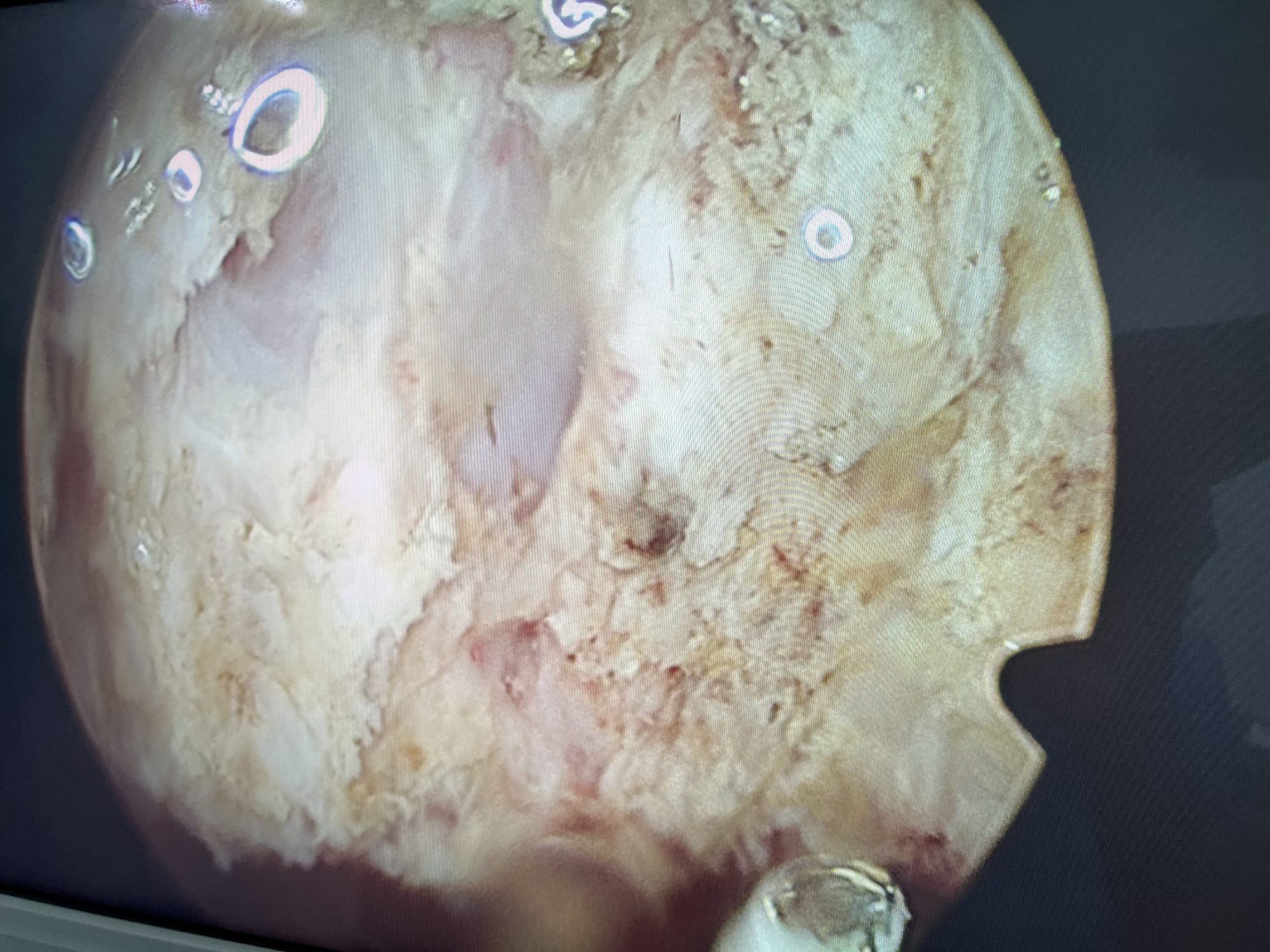 Adenoidectomy adenoidectomy
