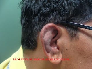 ear wax