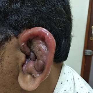 perichondritis - cauliflower ear