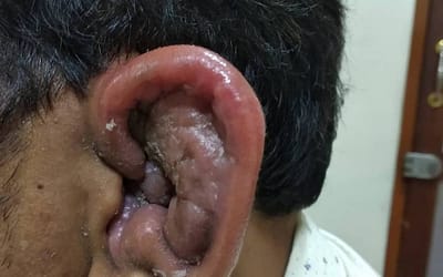 Perichondritis – Cauliflower ear – Cotton Ear Bud Damage