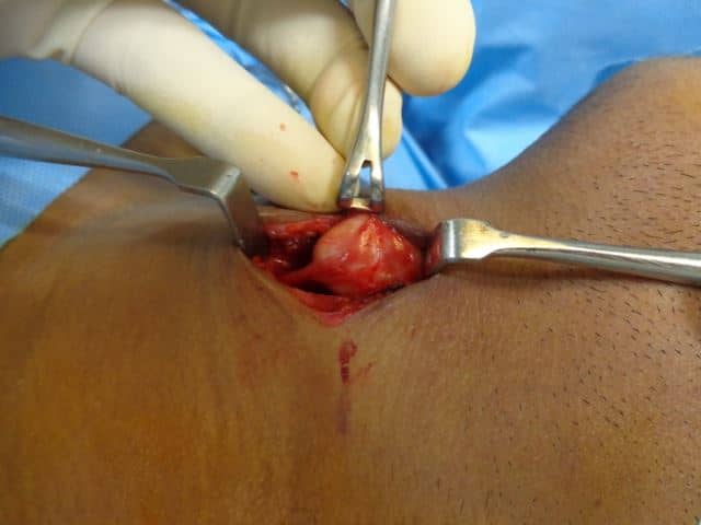 mini incision, drkumaresh, head and neck scarless thyroglossal surgery