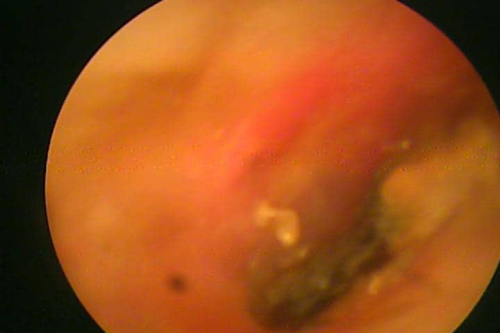 ear wax, ear bud, best ent, bangalore avoid ear buds