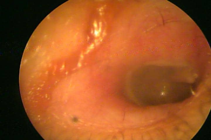who is an otolaryngologist ear wax