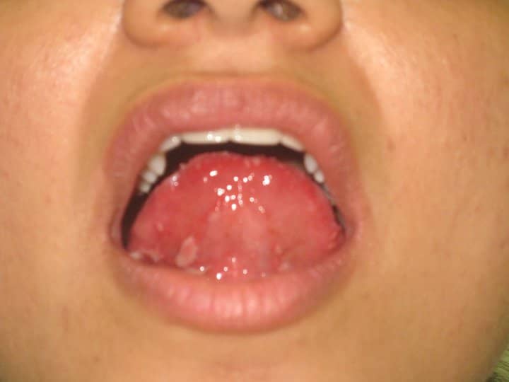 Aphthous Mouth Ulcers