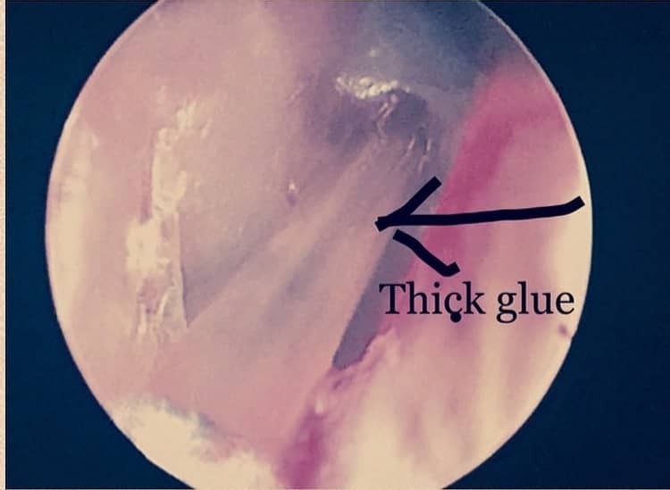 glue-ear-otitis-media-with-effusion-what-you-need-to-know